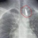 جراحة معقدة.. إنقاذ حياة طفل من غزة مصاب بمقذوف في صدره