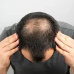 اكتشاف بالصدفة قد يغيّر علاج الصلع.. سكر بسيط يعيد إنبات الشعر